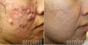 NeoClear before and after