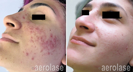NeoClear before and after