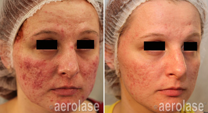 does NeoClear work