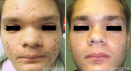 NeoClear in New Jersey