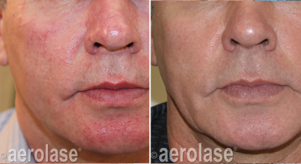 NeoClear treatment near me