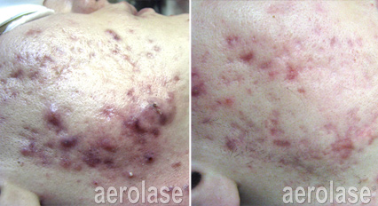 NeoClear treatments in New Jersey