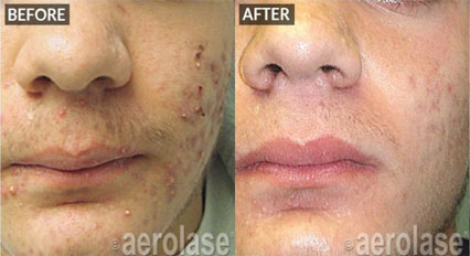 before and after NeoClear